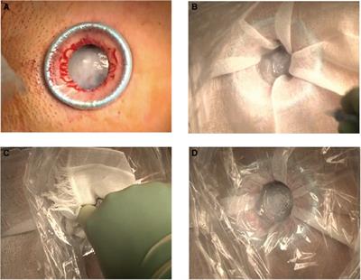 Modified Leak-Proof Puncture Technique for the Aspiration of Giant Ovarian Cysts by Instantly Mounting a Plastic Wrap and Gauze with Cyanoacrylates: A Retrospective Observational Study